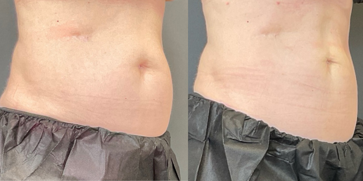 Hughes B&A CoolSculpting