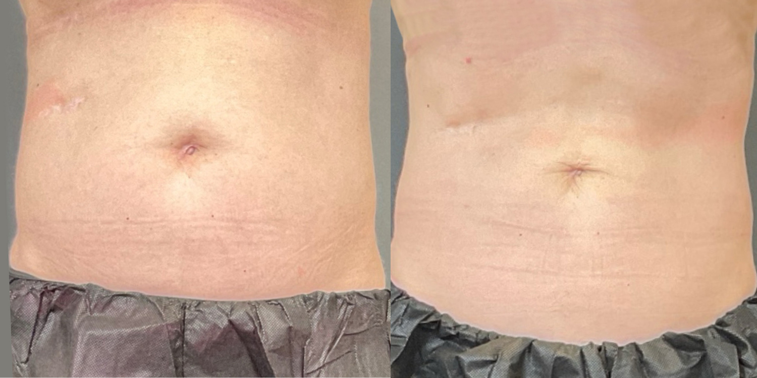 Hughes B&A CoolSculpting2