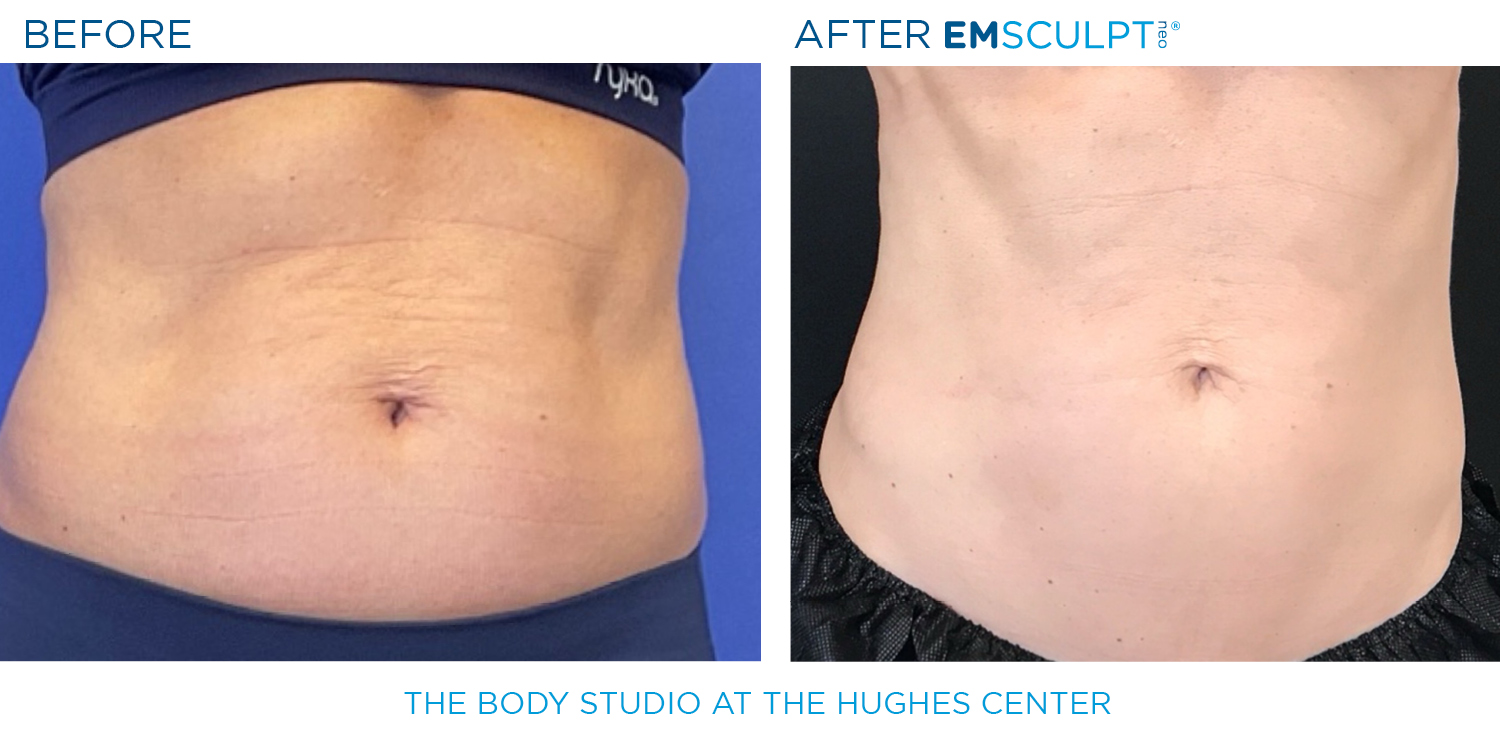 Hughes B&A Emsculpt