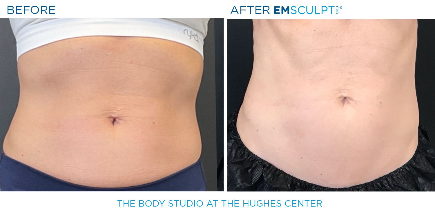 Hughes B&A Emsculpt24