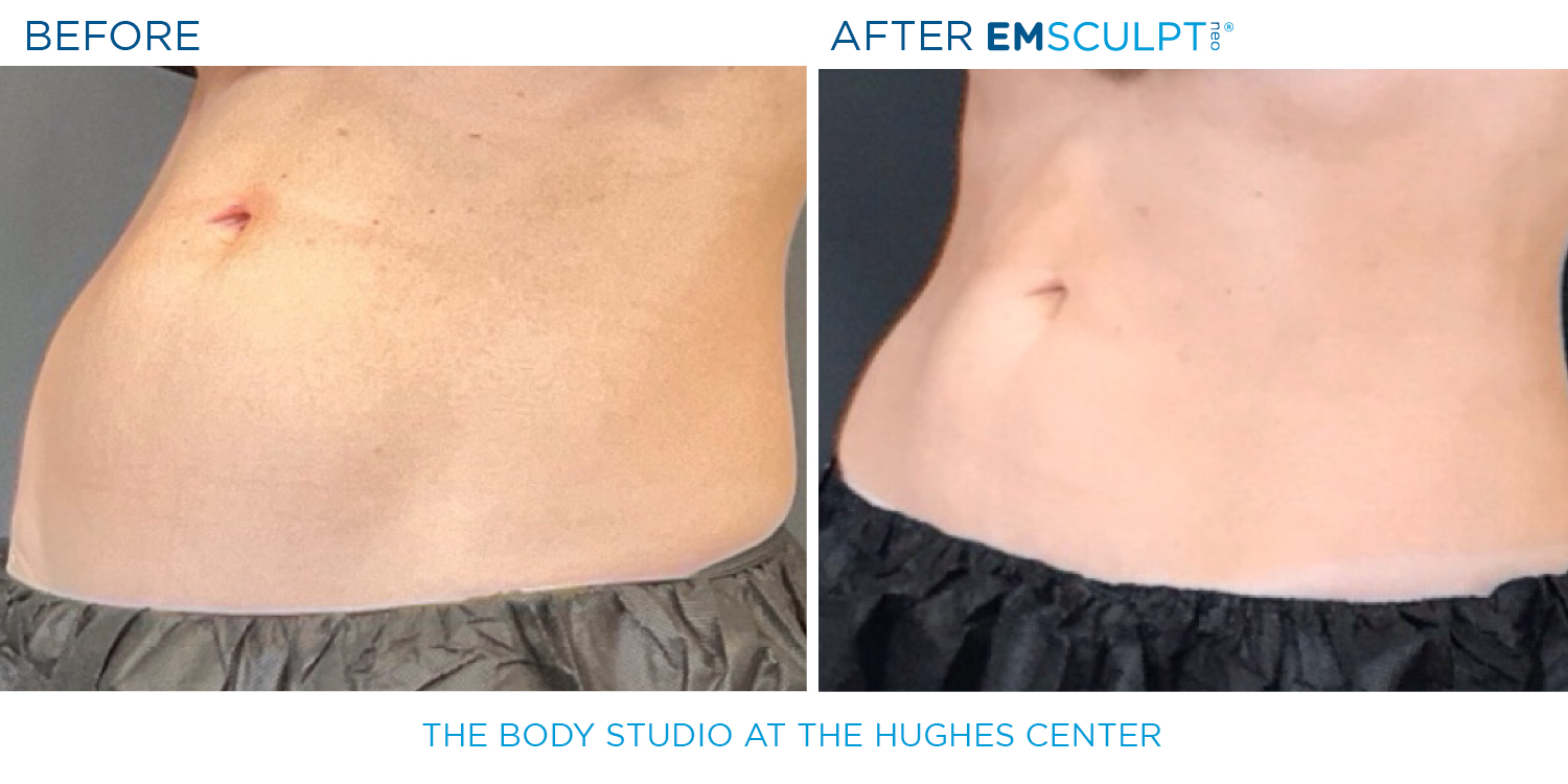 Hughes B&A Emsculpt25