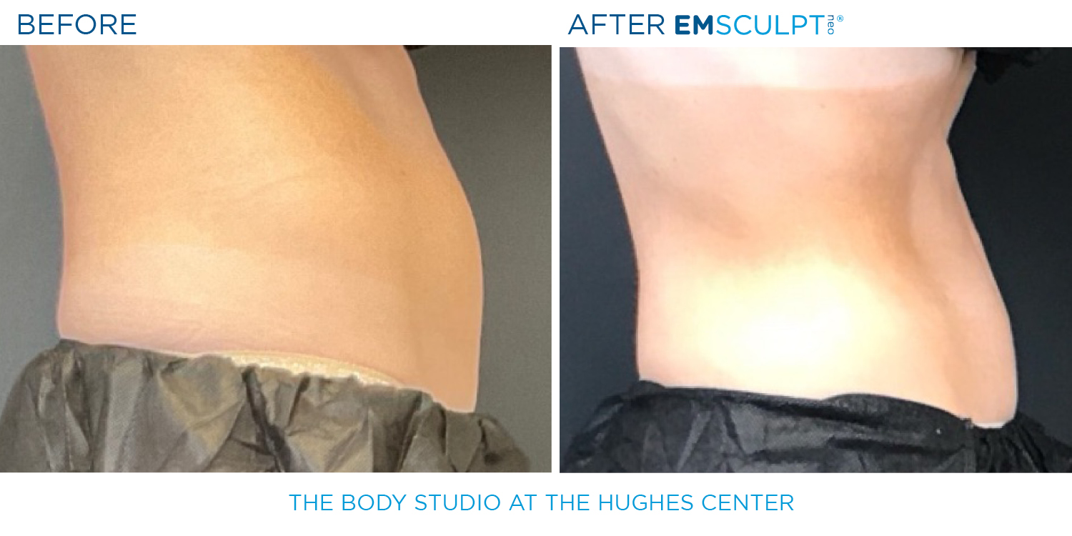 Hughes B&A Emsculpt26