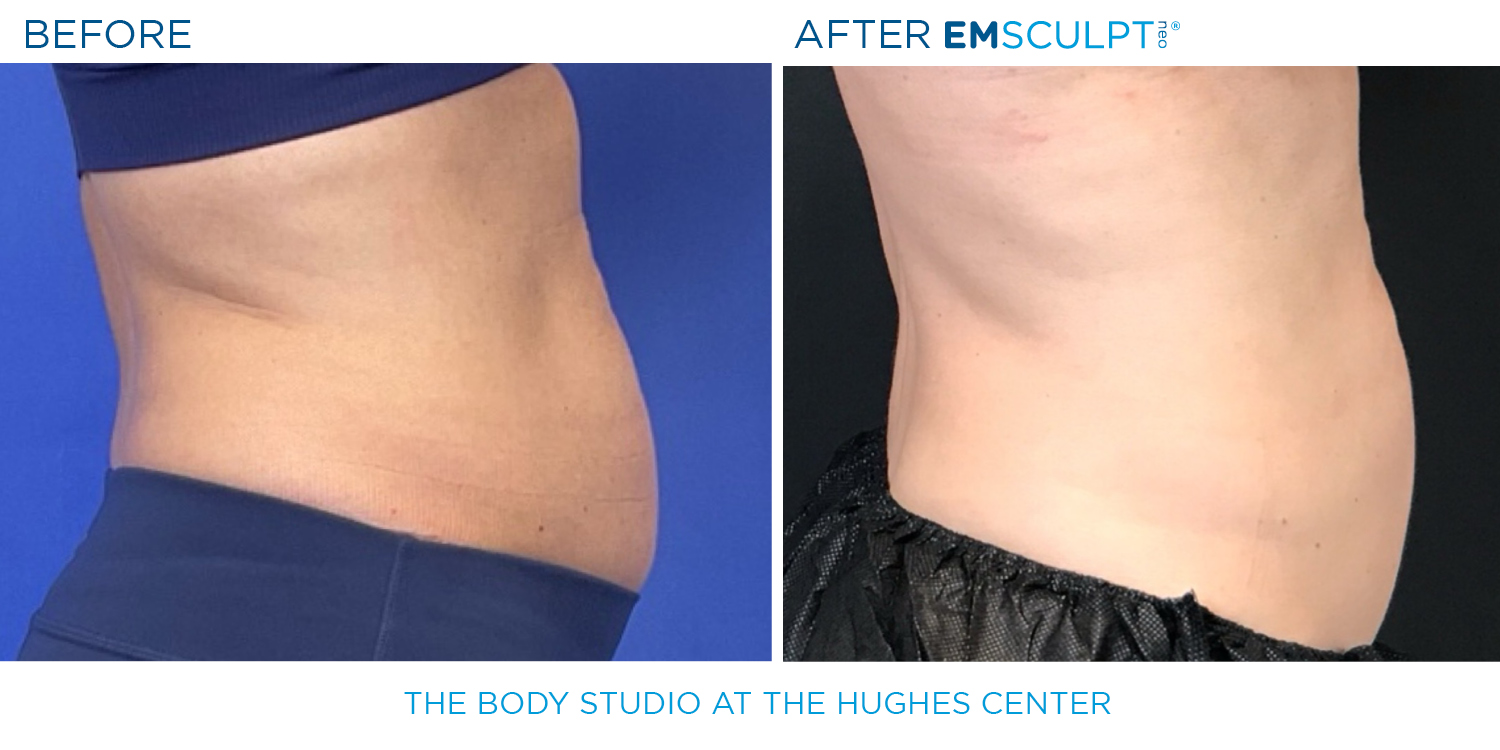 Hughes B&A Emsculpt3